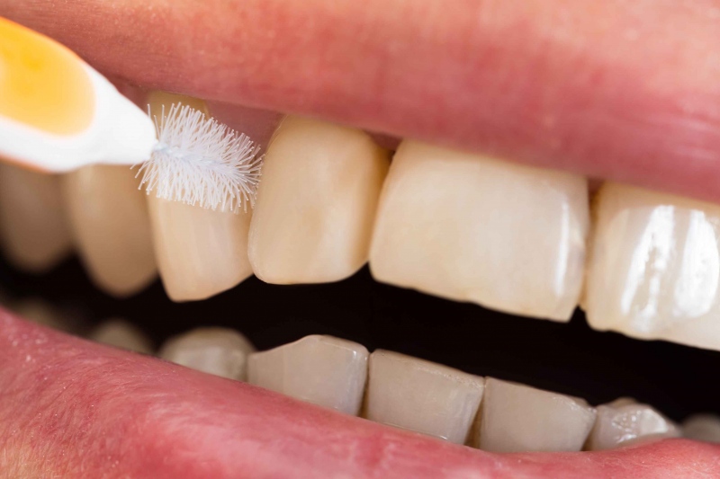 一般洗牙和激光洗牙的区别是什么帮助大家正确洗牙